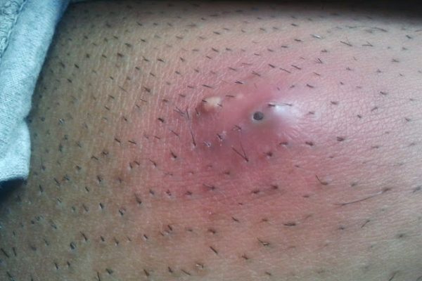 Five_day_old_Abscess