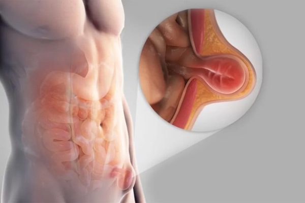 inguinal-and-umbilical-hernia-surgery