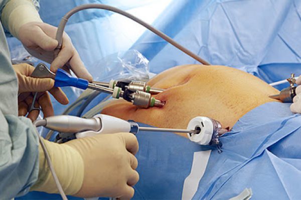 laproscopic-hysteroscopy-img