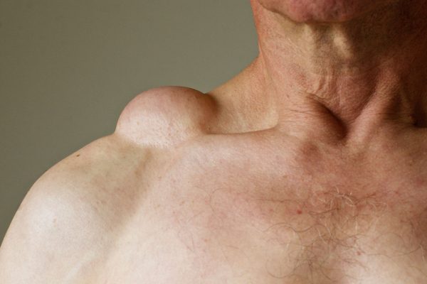 CYGBE3 A lipoma on a male's shoulder. A lipoma is a benign tumour, or fatty lump, consisting of soft tissue, and is non-malignant.