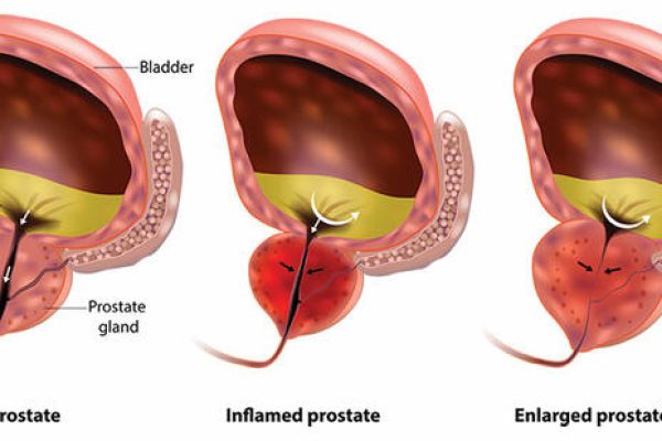 normal-inflamed-enlarged-prostate-difference